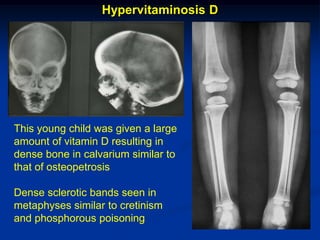 Hypervitaminosis D




This young child was given a large
amount of vitamin D resulting in
dense bone in calvarium similar to
that of osteopetrosis

Dense sclerotic bands seen in
metaphyses similar to cretinism
and phosphorous poisoning
 