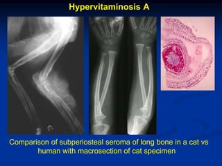 Hypervitaminosis A




Comparison of subperiosteal seroma of long bone in a cat vs
       human with macrosection of cat specimen
 