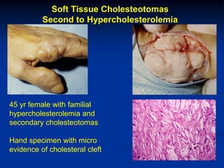Soft Tissue Cholesteotomas
          Second to Hypercholesterolemia




45 yr female with familial
hypercholesterolemia and
secondary cholesteotomas

Hand specimen with micro
evidence of cholesteral cleft
 