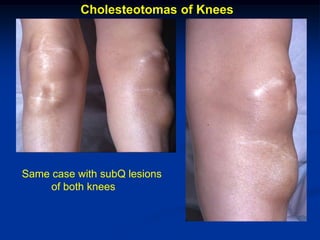 Cholesteotomas of Knees




Same case with subQ lesions
     of both knees
 