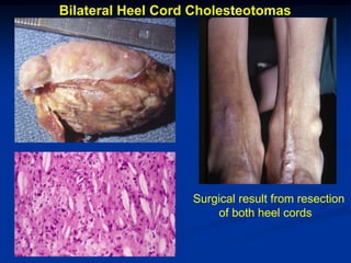 Bilateral Heel Cord Cholesteotomas




                   Surgical result from resection
                       of both heel cords
 