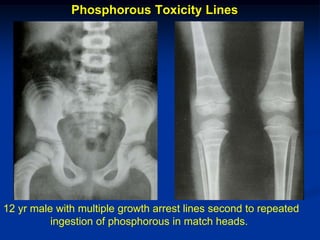 Phosphorous Toxicity Lines




12 yr male with multiple growth arrest lines second to repeated
          ingestion of phosphorous in match heads.
 