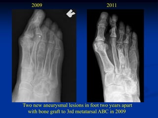2009                              2011




Two new aneurysmal lesions in foot two years apart
  with bone graft to 3rd metatarsal ABC in 2009
 