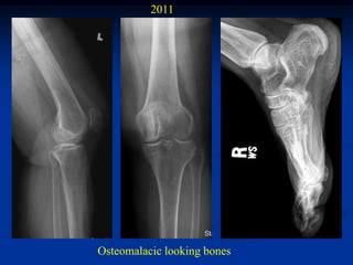 2011




Osteomalacic looking bones
 