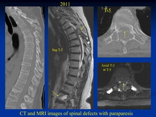 2011
                                      T-5




              Sag T-2



                                     Axial T-2
                                      at T-5




CT and MRI images of spinal defects with paraparesis
 