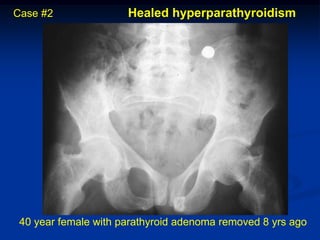 Case #2               Healed hyperparathyroidism




 40 year female with parathyroid adenoma removed 8 yrs ago
 