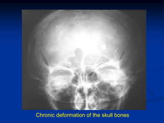 Chronic deformation of the skull bones
 