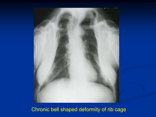 Chronic bell shaped deformity of rib cage
 