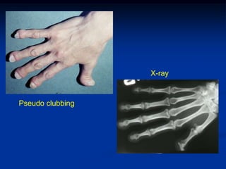 X-ray



Pseudo clubbing
 