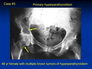 Case #3              Primary hyperparathyroidism




48 yr female with multiple brown tumors of hyperparathyroidism
 