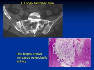 CT scan sacroiliac area




Iliac biopsy shows
increased osteoclastic
activity
 