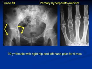 Case #4                   Primary hyperparathyroidism




  39 yr female with right hip and left hand pain for 6 mos
 