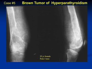 Case #5   Brown Tumor of Hyperparathyroidism




                   25 yr female
                   Pain 3 mos
 