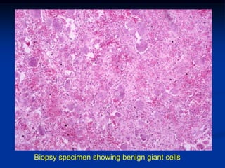 Biopsy specimen showing benign giant cells
 