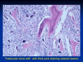 Trabecular bone with with thick pink staining osteoid seams
 