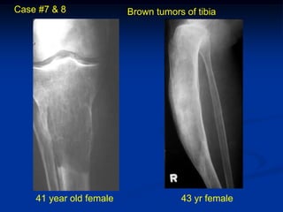 Case #7 & 8              Brown tumors of tibia




    41 year old female               43 yr female
 