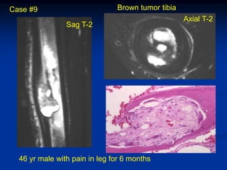 Case #9                        Brown tumor tibia
                                                   Axial T-2
                Sag T-2




  46 yr male with pain in leg for 6 months
 