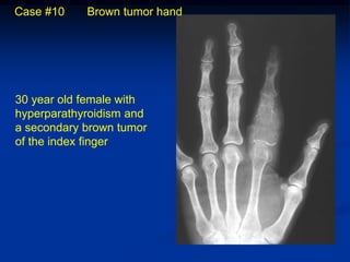 Case #10    Brown tumor hand




30 year old female with
hyperparathyroidism and
a secondary brown tumor
of the index finger
 