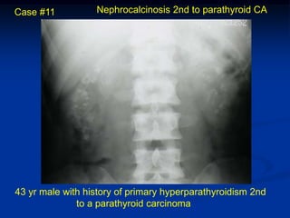 Case #11          Nephrocalcinosis 2nd to parathyroid CA




43 yr male with history of primary hyperparathyroidism 2nd
              to a parathyroid carcinoma
 