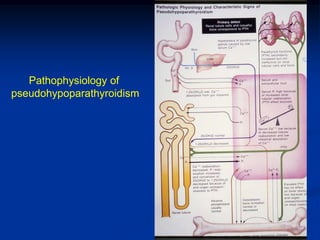 Pathophysiology of
pseudohypoparathyroidism
 