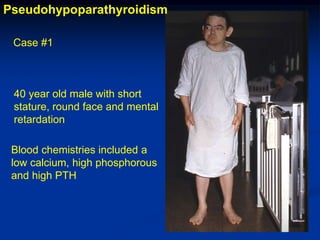 Pseudohypoparathyroidism

 Case #1



 40 year old male with short
 stature, round face and mental
 retardation

 Blood chemistries included a
 low calcium, high phosphorous
 and high PTH
 