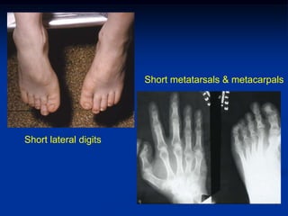 Short metatarsals & metacarpals




Short lateral digits
 