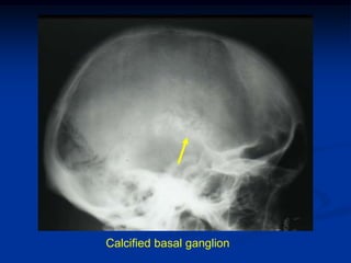 Calcified basal ganglion
 