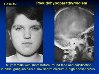 Case #2               Pseudohypoparathyroidism




    18 yr female with short stature, round face and calcification
in basal ganglion plus a low serum calcium & high phosphorous
 