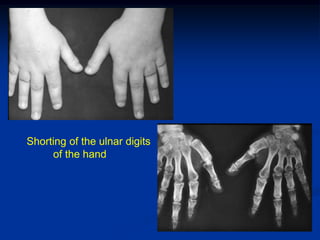 Shorting of the ulnar digits
     of the hand
 