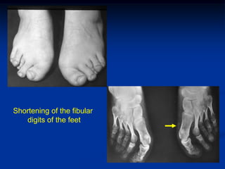 Shortening of the fibular
   digits of the feet
 
