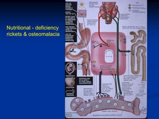 Nutritional - deficiency
rickets & osteomalacia
 