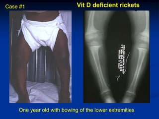 Case #1                     Vit D deficient rickets




    One year old with bowing of the lower extremities
 