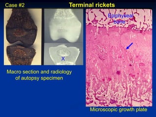 Case #2                   Terminal rickets
                                        Epiphyseal
                                          bone




                      X

Macro section and radiology
   of autopsy specimen




                                 Microscopic growth plate
 