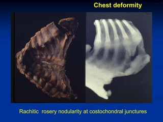 Chest deformity




Rachitic rosery nodularity at costochondral junctures
 