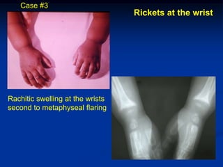 Case #3
                                  Rickets at the wrist




Rachitic swelling at the wrists
second to metaphyseal flaring
 