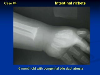 Case #4                            Intestinal rickets




          6 month old with congenital bile duct atresia
 