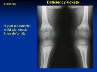 Case #5               Deficiency rickets




4 year old rachitic
child with knock-
knee deformity
 