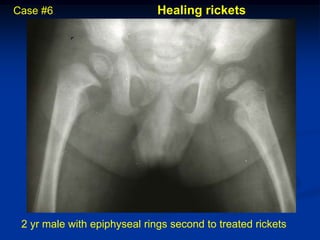 Case #6                       Healing rickets




 2 yr male with epiphyseal rings second to treated rickets
 