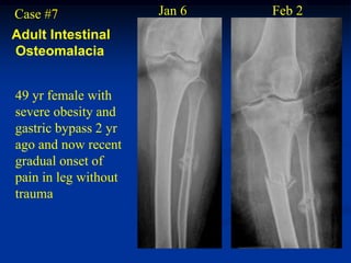 Case #7               Jan 6   Feb 2
Adult Intestinal
Osteomalacia


49 yr female with
severe obesity and
gastric bypass 2 yr
ago and now recent
gradual onset of
pain in leg without
trauma
 