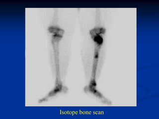 Isotope bone scan
 