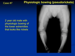 Case #7            Physiologic bowing (pseudorickets)




 2 year old male with
 physiologic bowing of
 the lower extremities
 that looks like rickets
 