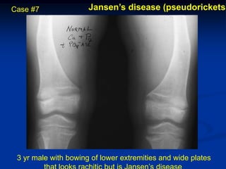 Case #7               Jansen’s disease (pseudorickets)




 3 yr male with bowing of lower extremities and wide plates
 