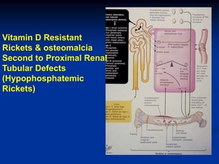 Vitamin D Resistant
Rickets & osteomalcia
Second to Proximal Renal
Tubular Defects
(Hypophosphatemic
Rickets)
 