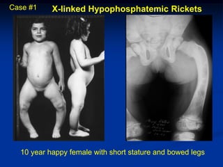 Case #1    X-linked Hypophosphatemic Rickets




  10 year happy female with short stature and bowed legs
 