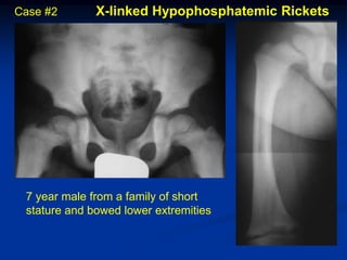 Case #2       X-linked Hypophosphatemic Rickets




 7 year male from a family of short
 stature and bowed lower extremities
 