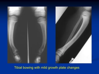 Tibial bowing with mild growth plate changes
 