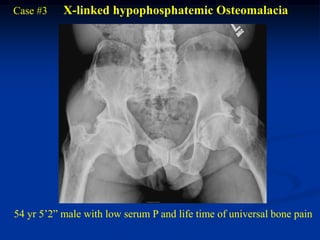 Case #3    X-linked hypophosphatemic Osteomalacia




54 yr 5’2” male with low serum P and life time of universal bone pain
 