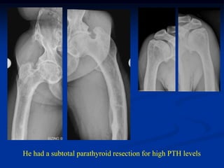 He had a subtotal parathyroid resection for high PTH levels
 