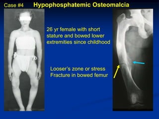 Case #4   Hypophosphatemic Osteomalcia


             26 yr female with short
             stature and bowed lower
             extremities since childhood




              Looser’s zone or stress
              Fracture in bowed femur
 