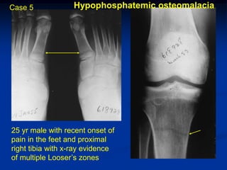 Case 5            Hypophosphatemic osteomalacia




25 yr male with recent onset of
pain in the feet and proximal
right tibia with x-ray evidence
of multiple Looser’s zones
 